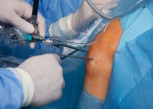 Arthroscopic knee surgery: one of the treatments limited in Washington state’s Health Technology Assessment program